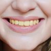 Qué significa tener los dientes amarillos